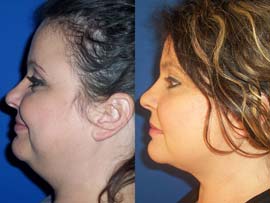 chin liposuction lookalike